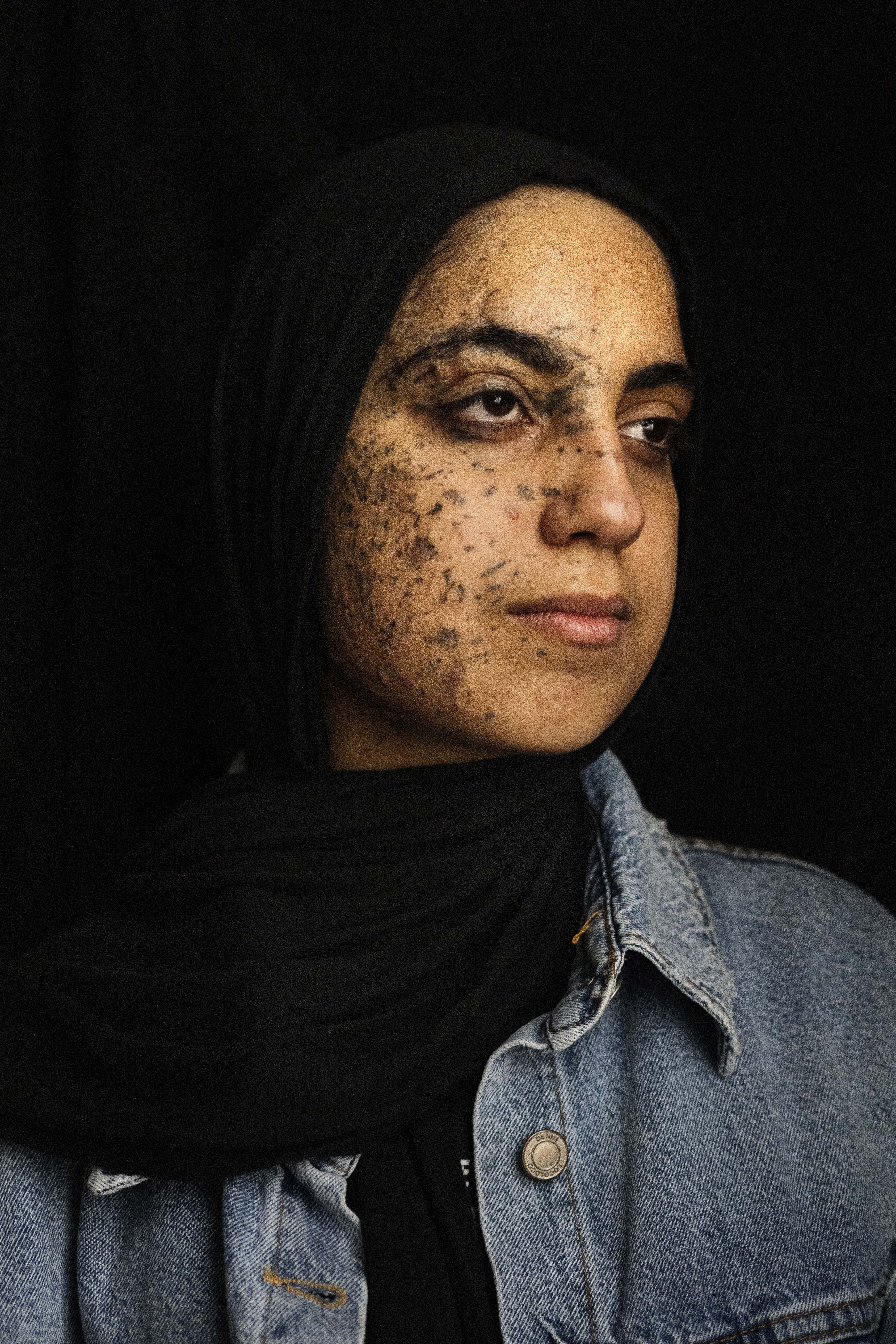 Basant Al-Louh suffered chemical burns, shrapnel wounds to her face, and an amputated ear. She also lost her parents in the bombing of their home