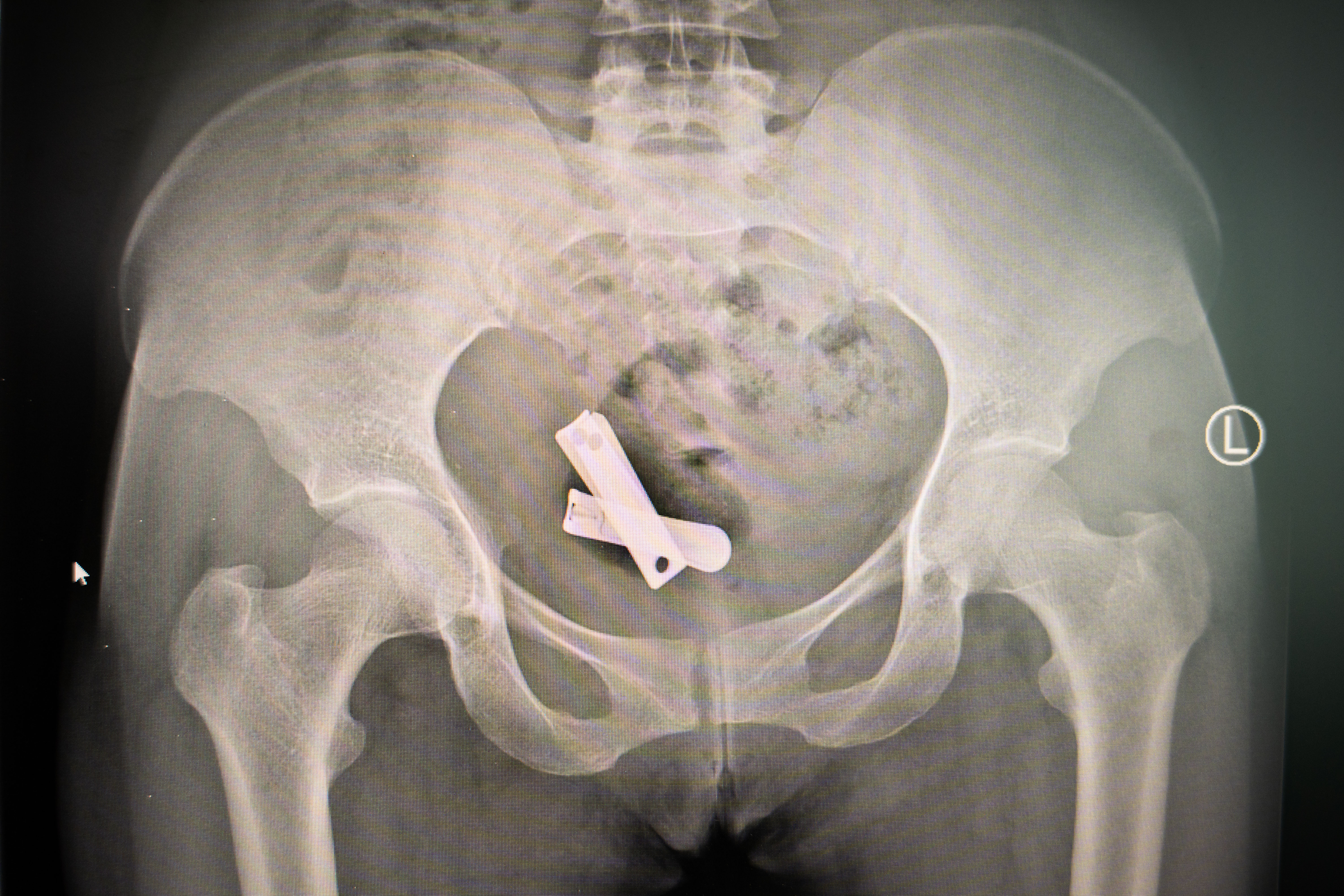 X-ray image showing a nail clipper inserted inside a uterus, Mekele, Tigray, March 2025.